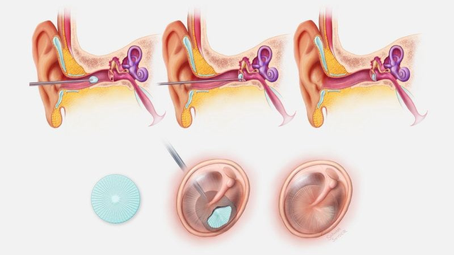PhonoGraft可以通过耳道植入 PhonoGraft可以通过耳道植入