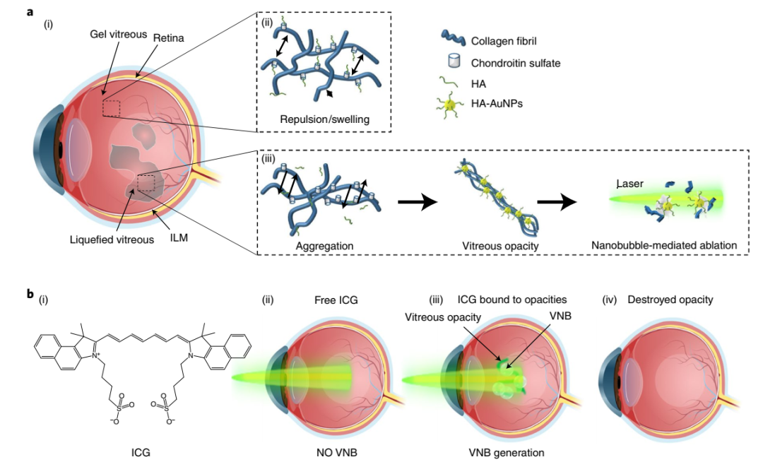 玻璃体液化和纳米气泡介导的玻璃体混浊消融概念 玻璃体液化和纳米气泡介导的玻璃体混浊消融概念