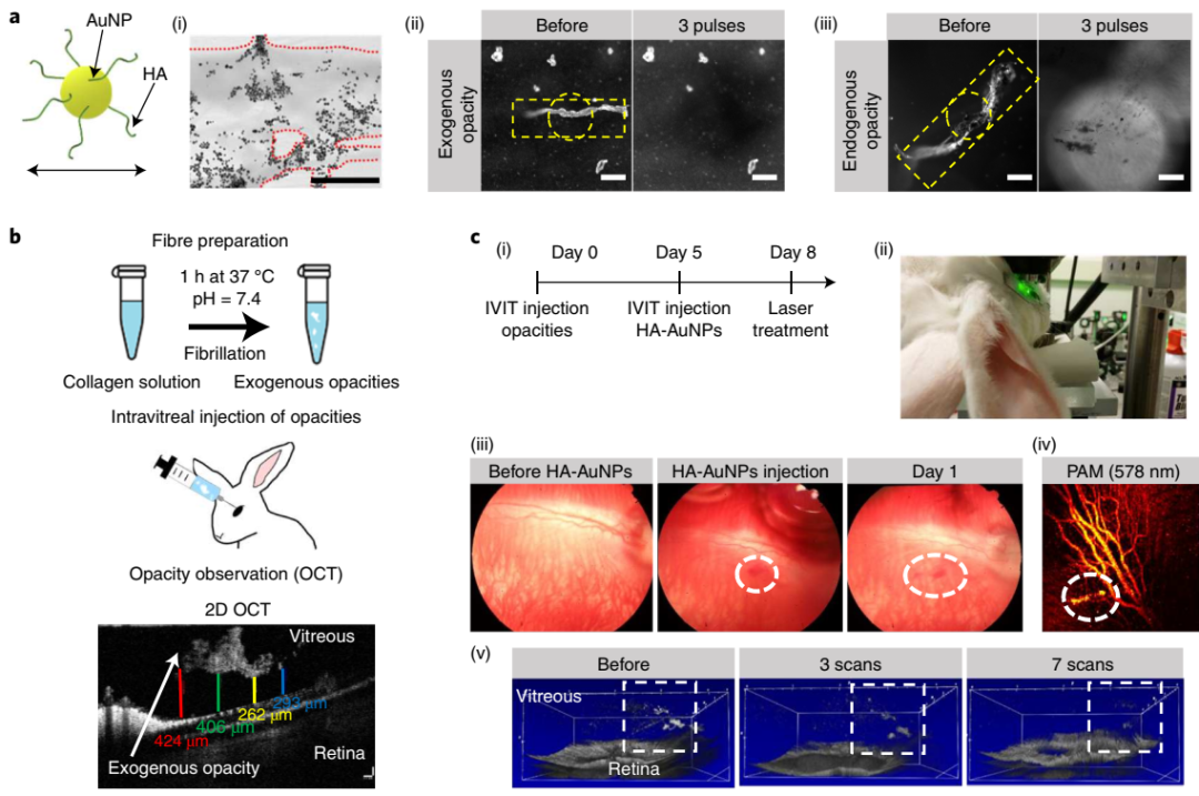 激光消融金纳米颗粒的玻璃体混浊 激光消融金纳米颗粒的玻璃体混浊