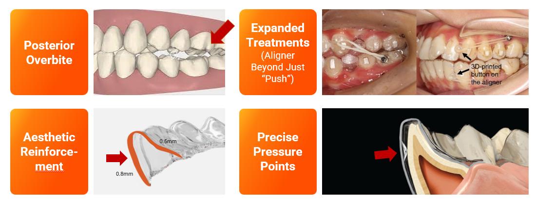 牙套创新:个性化设计牙套厚度、长度、附件,精准施力,满足更多适应症需求 牙套创新:个性化设计牙套厚度、长度、附件,精准施力,满足更多适应症需求